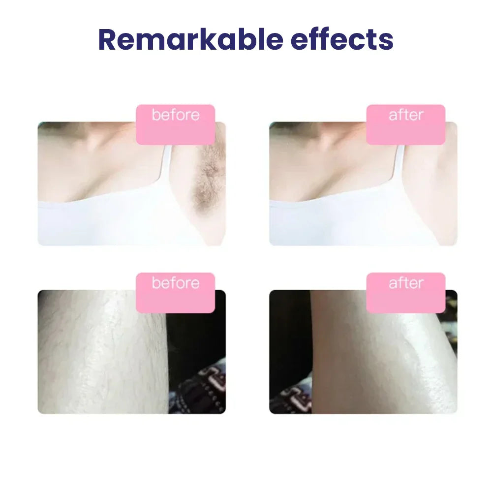 IPL Laser Hair Removal Device Permanent Hair Remover for Face & Body